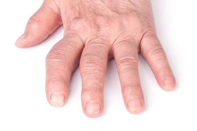 деформираща артроза на ръцете