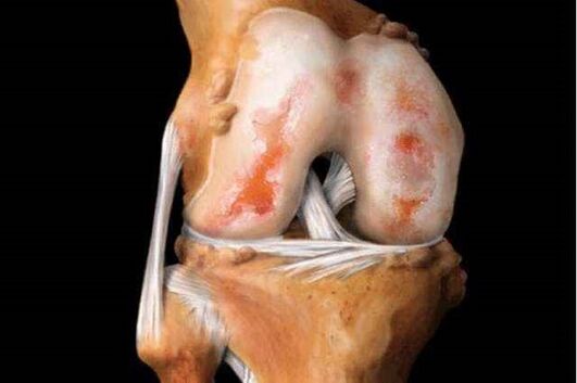 увреждане на колянната става с артроза
