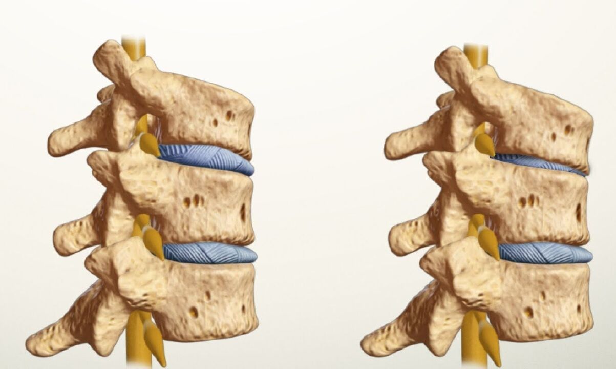 здрав и болен гръбначен стълб с лумбална остеохондроза