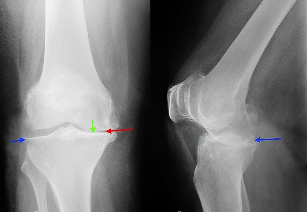рентгенова снимка на артроза на колянната става