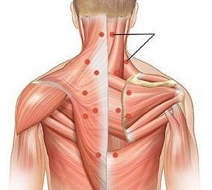 миозит като причина за болки в гърба