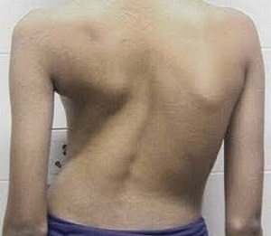 сколиоза като причина за болки в гърба
