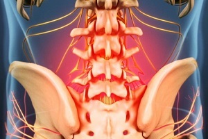 причини и симптоми на остеохондроза
