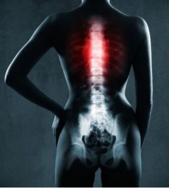 Засегнатата област на гръбначния стълб с гръдна остеохондроза