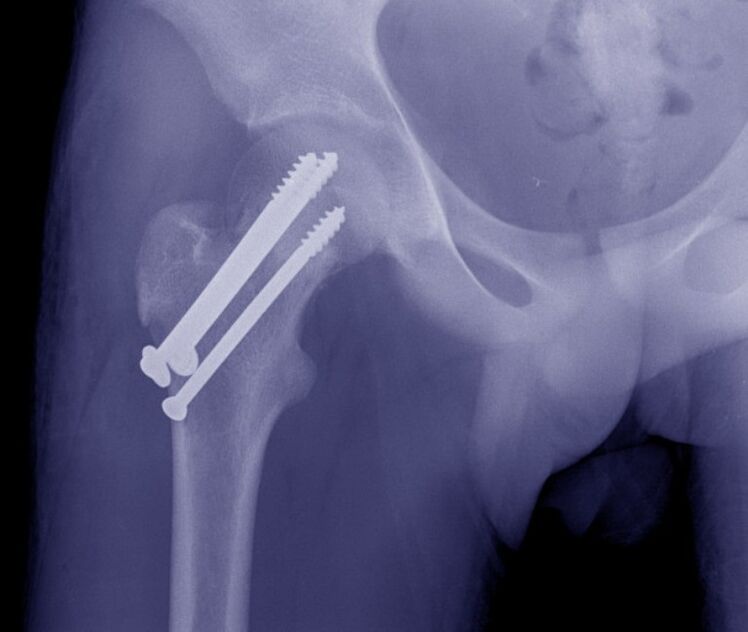 Рентгенова снимка на тазобедрената става, остеосинтеза на фрактурата с устройства за вътрешно фиксиране