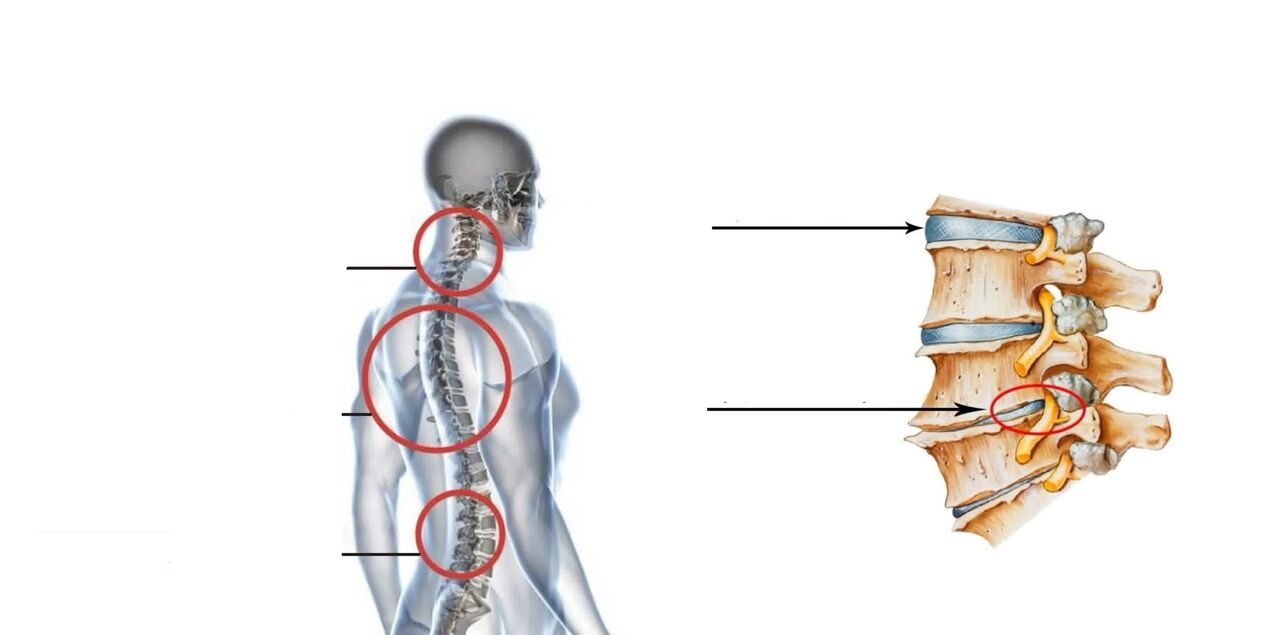 остехондроза на гръбначния стълб
